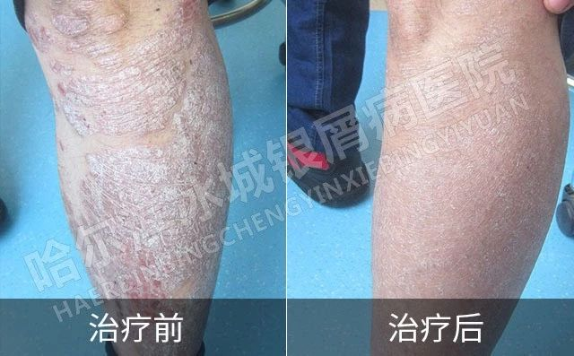 寻常型银屑病护理,寻常型银屑病如何护理